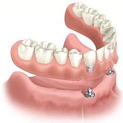 dental implant